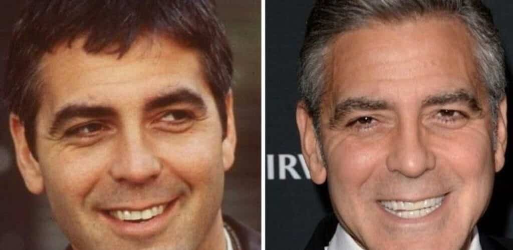 George Clooney Teeth Before After George Clooney Teeth Before After